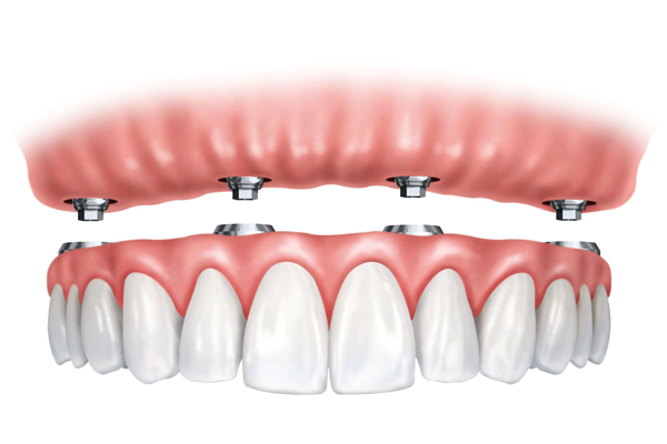 Implant supported bridges