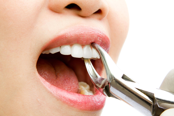 Tooth Extraction